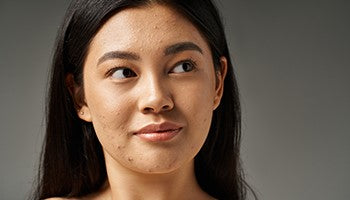 Acne-Prone Skin