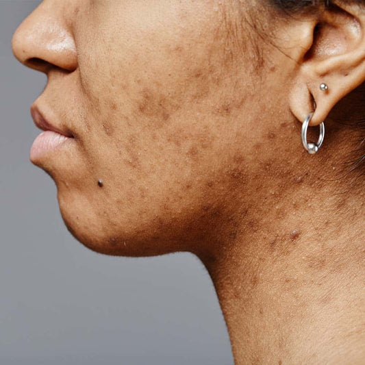 Hyperpigmentation