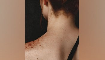 Pigmentation