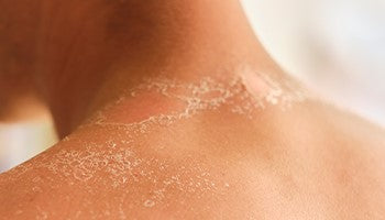 Skin Peeling