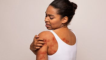 Sweat Rash