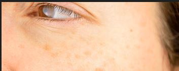 Hyperpigmentation- Causes, treatments and Home Remedies