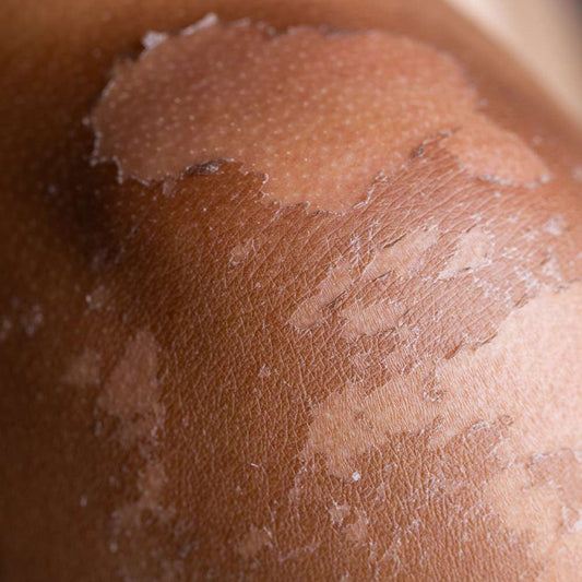 Peeling Skin