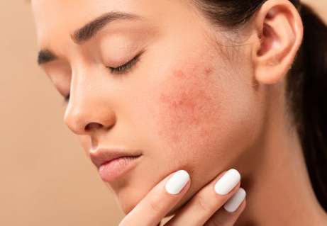 Skincare for Acne Scars