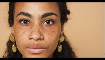 Hyperpigmentation