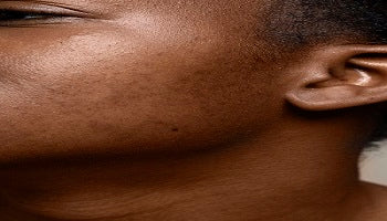 How to Fade Dark Spots in Darker Skin Tones