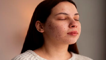 10 Natural Home Remedies for Pigmentation and Dark Spots on Face